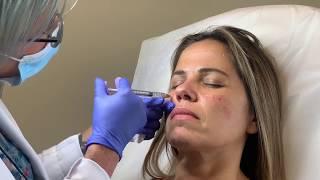 Cheeks and Nasolabial Folds treatment with Dermal Filler at Well Medical Arts