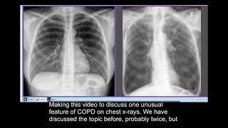 Chest Xray : Smockers disease COPD unusual CXR - Sabre sheath trachea ( by hammadshams)