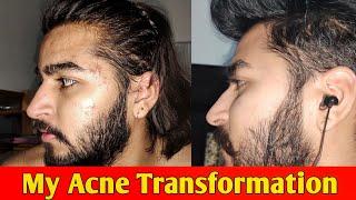 My Acne Transformation Before And After | Sahil Nagpal