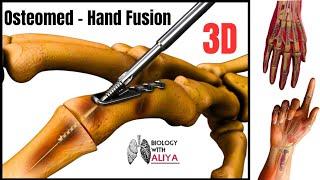 Osteomed - Hand Fusion | medical animation | medical animation video | Biology with Aliya