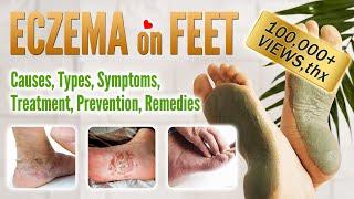 Eczema on foot Causes, Symptoms, Types, Treatment, Prevention and Home Remedies | Feet Eczema