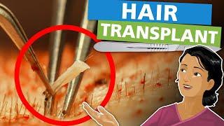 Hair Transplant