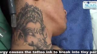 LASER TATTOO REMOVAL COST