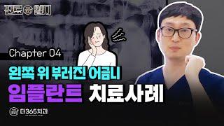 왼쪽 위 부러진 어금니 ▶ 발치 후 즉시 임플란트 사례 | 연중무휴 치과 【더365치과】 진료일지 #4