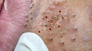 Big Cystic Acne Blackheads Extraction Blackheads & Milia, Whiteheads Removal Pimple Popping # 1355