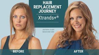 Trichotillomania and Non-Surgical Hair Replacement Options