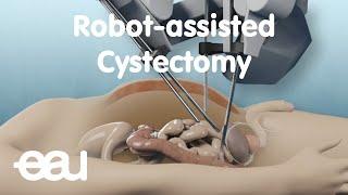 Robot-Assisted Cystectomy