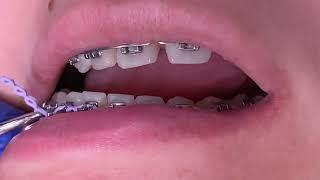 Braces checkups - Power chains & Bite plate off - Tooth Time Family Dentistry