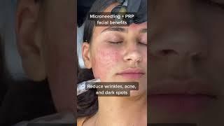 Top benefits of PRP Facial and Microneedling