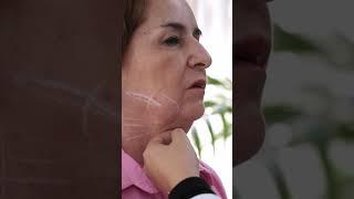 Lipopapada, acompáñame a una valoración antes de la cirugía |Dr Jessica García, perfilamiento facial