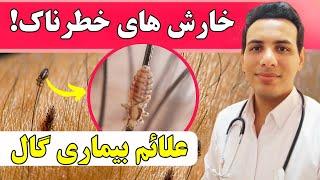 چرا باید خارش پوست را جدی گرفت؟ | علائم گال و درمان خانگی آن