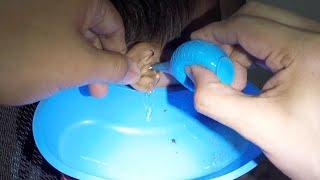 Boy's Earwax Removed & Shattered to Pieces