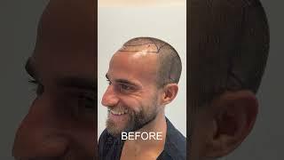 HAIR TRANSFORMATION 6 MONTHS UPDATE - HAIR TRANSPLANT