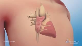 Understanding Atrial Septal Defect (ASD)