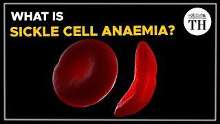 What is sickle cell anaemia? | The Hindu