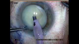 "Great White" Cataract Surgery