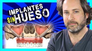 ¿Que son los IMPLANTES CIGOMATICOS?  [SOLUCION ]Para poner IMPLANTES DENTALES cuando NO hay HUESO