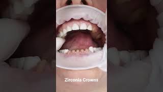 Single zirconia crowns #zirconia #zirconiacrown #dentist #teethtalk