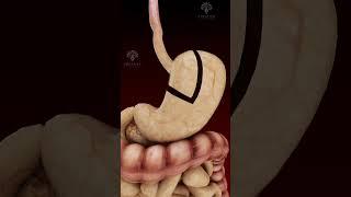 Gastric Bypass |Laparoscopic Treatment| #shorts - creativelearning3d