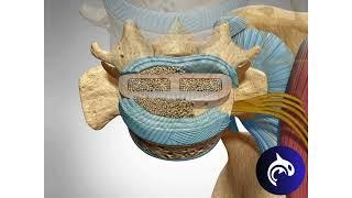 Quick View - Lateral Lumbar Interbody Fusion (LLIF) - 3D Animation.