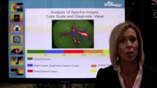 Anastasia Turchetta, RDH, discusses the Spectra caries detection system-full version