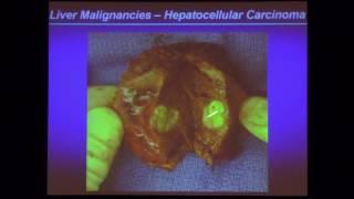 Update on Liver Cancer - Vatche G. Agopian, MD | UCLA Primary Care Update 2015