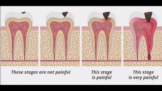 Stages of Tooth Decay: Introduction