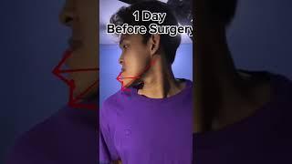 Jaw Surgery + Braces Explained  Underbite With Anterior Open Bite