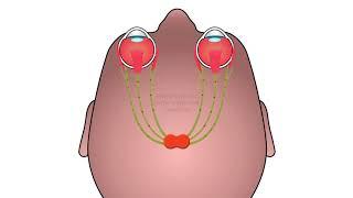 Trigeminal Dysphoria 1min