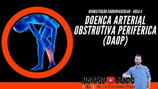 Reabilitação Cardiovascular - Aula 4: Doença Arterial Obstrutiva Crônica (DAOP) Prof. Otávio Plazzi