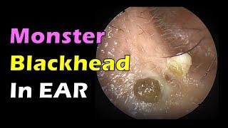 Monster Blackhead in Ear