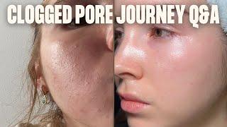 CLOSED COMEDONES | Q&A Clogged pores & my retinoid journey