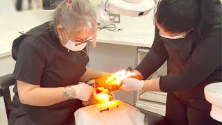 DENTAL SEALANTS FOR KIDS TEETH