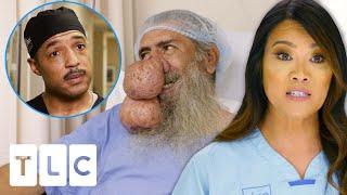 Dr. Lee & Specialists Finally Remove Roger's Enormous Rynophyma! | Dr. Pimple Popper