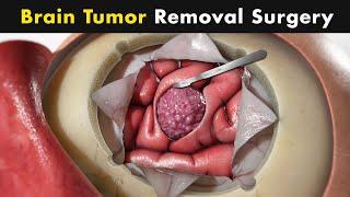 How Brain Tumor Surgery is performed? (Urdu/Hindi)