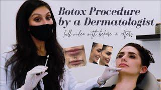 Botox Procedure with Before + Afters|Preventative & Lip Flip| What you NEED to know|Dr. Sheila Derm