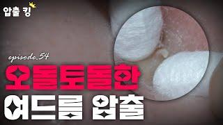 [압출킹]54 오돌토돌 좁쌀 형태의 여드름 압출SMR #여드름압출 #여드름 #압출영상