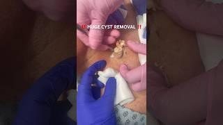 EPIC cyst removal!  #cystpoping #extraction #oddlysatisfying #satisfying #pop