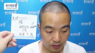 【植髮日記】#M型禿 的他來到了雍禾植髮│術后12個月成果│Yonghe hair transplant