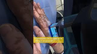 Excimer Laser Vitiligo Treatment in Zirakpur  | The Skin Zeal | Dr. Isha V. Mittal | Call 7293939326