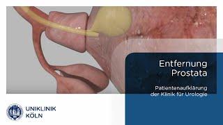 Prostatakrebs | Entfernung der Prostata (Klinik für Urologie Patienteninformation) | Uniklinik Köln.