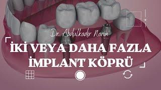 İki veya Daha Fazla İmplantlı Köprü