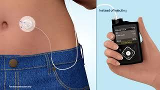 What is an insulin pump?