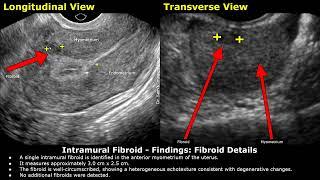 Intramural Fibroid Ultrasound Report Example | Uterine Leiyomyomas | Uterus Sonography | Radiology