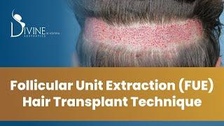 Follicular Unit Extraction (FUE) Hair Transplant Technique