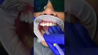 Veneers removal  #dentist #veneers #shorts