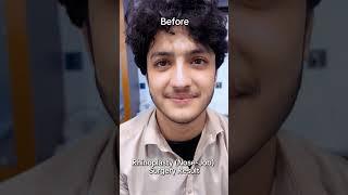 Rhinoplasty Transformation Reveal!  Stunning Nose Job by Dr. Habib  | Peshawar, Pakistan 