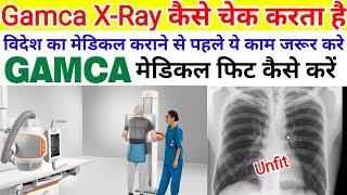 X-Ray Fit kaise kare | X-ray check kaise kare | gamca medical xray unfit kaise thik kare | #gamca