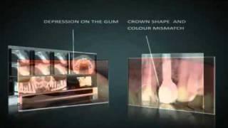 Dental Implants Restoration and Repair