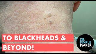 To Blackheads & Beyond!